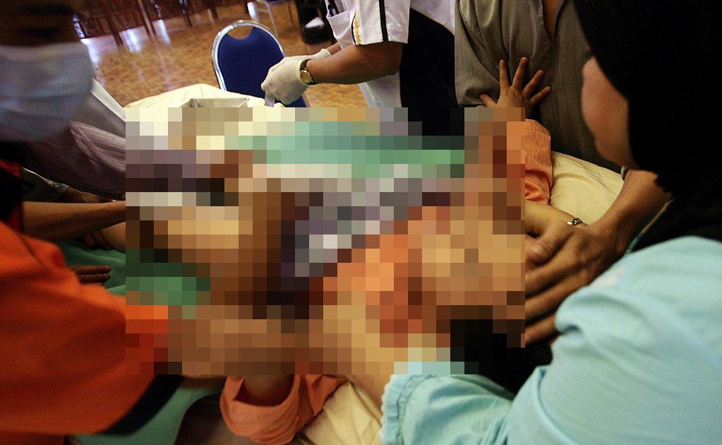 Trasplantan cráneo impreso en 3D a niña con hidrocefalia