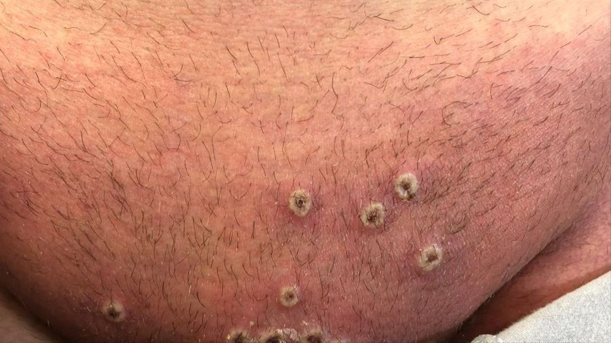 Pústules que surten a conseqüència d'haver-se infectat de la verola del mico.