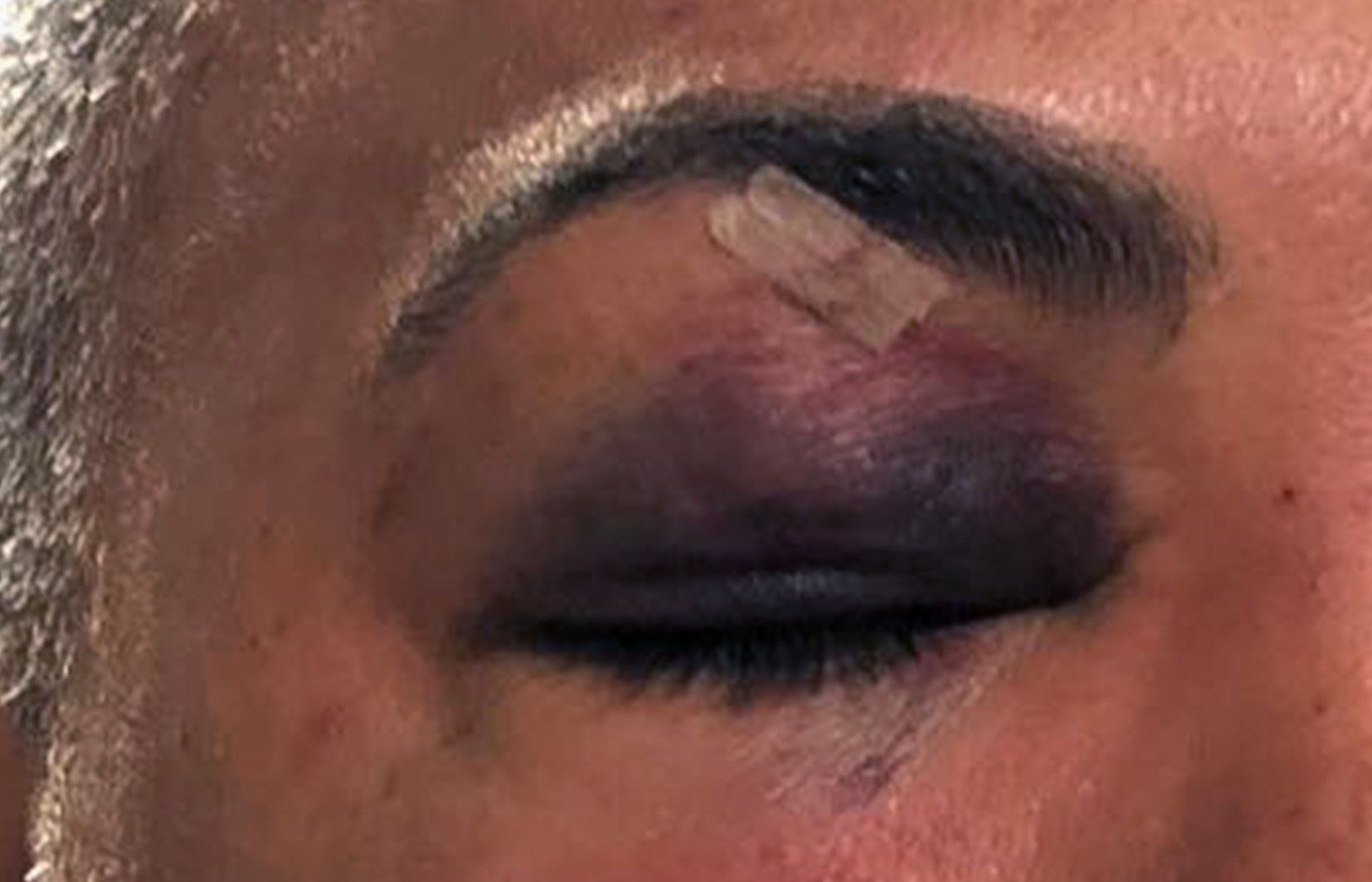 Ull de vellut que presentava una de les víctimes hores després dels fets i un cop ja tractat a l\'hospital.