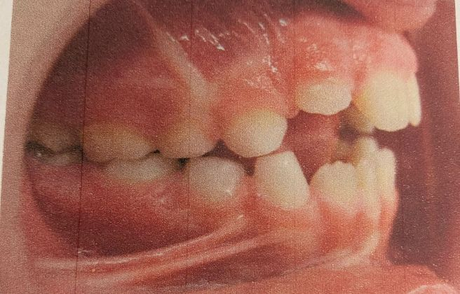 Dentadura afectada per una malaltia minoritària.