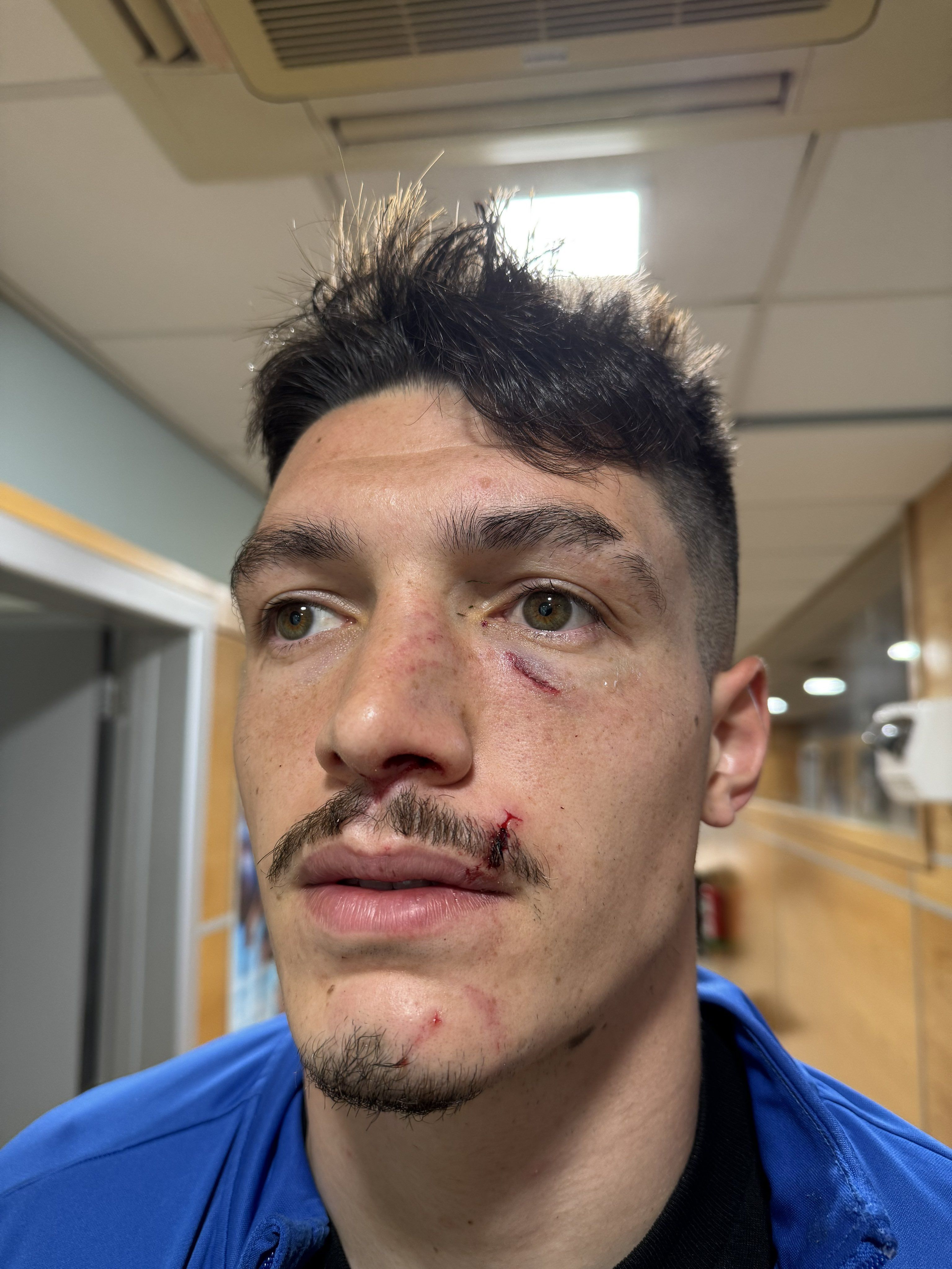 Així ha quedat la cara de Lauti després de ser suturat pels doctors. Així ha quedat la cara de Lauti després de ser suturat pels doctors.