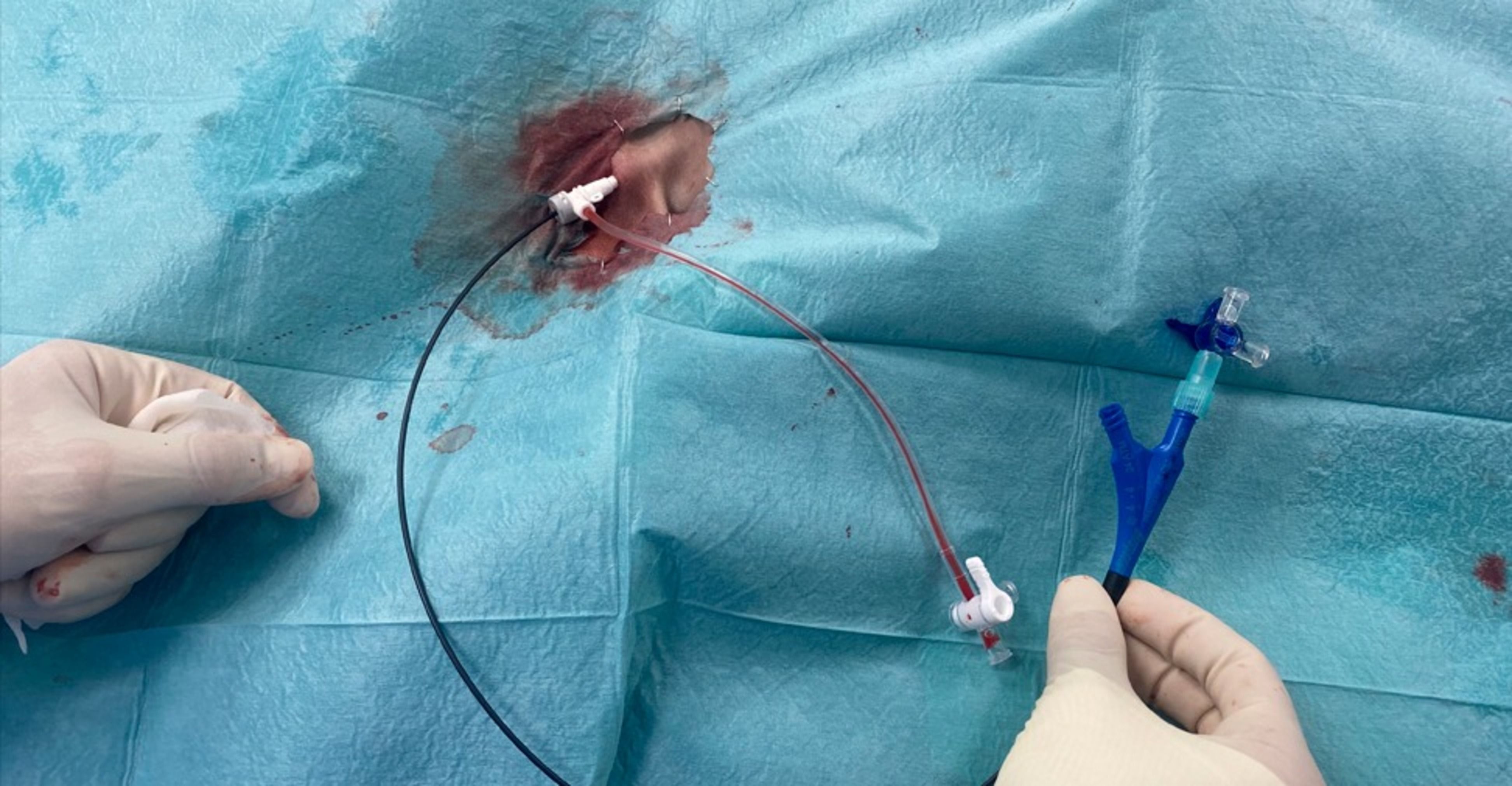 Una intervenció per 'shunt porto cava'.