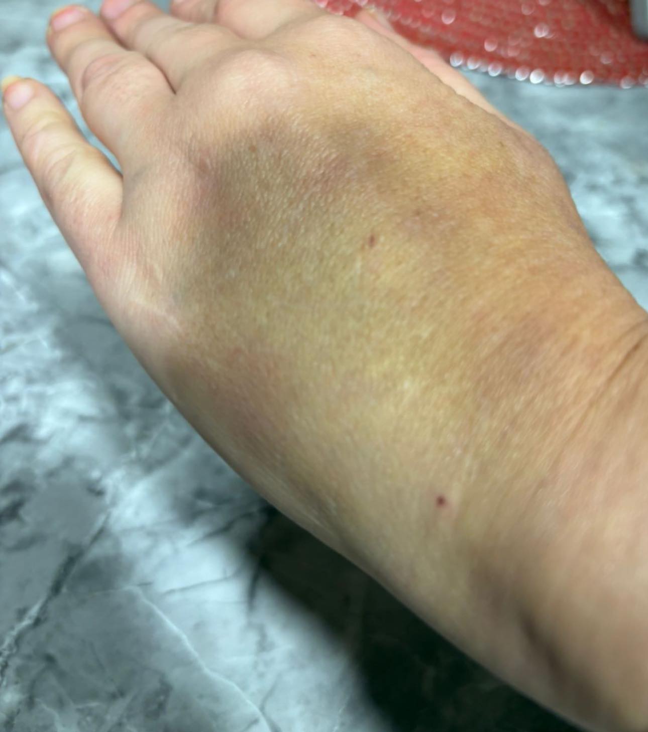 El morat que li va sortir a la mà a la dona que ha presentat la denúncia.