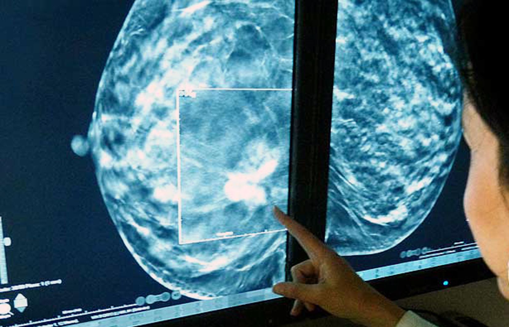 Mostra d'una tomosintesis, que serveix per detectar la malaltia.