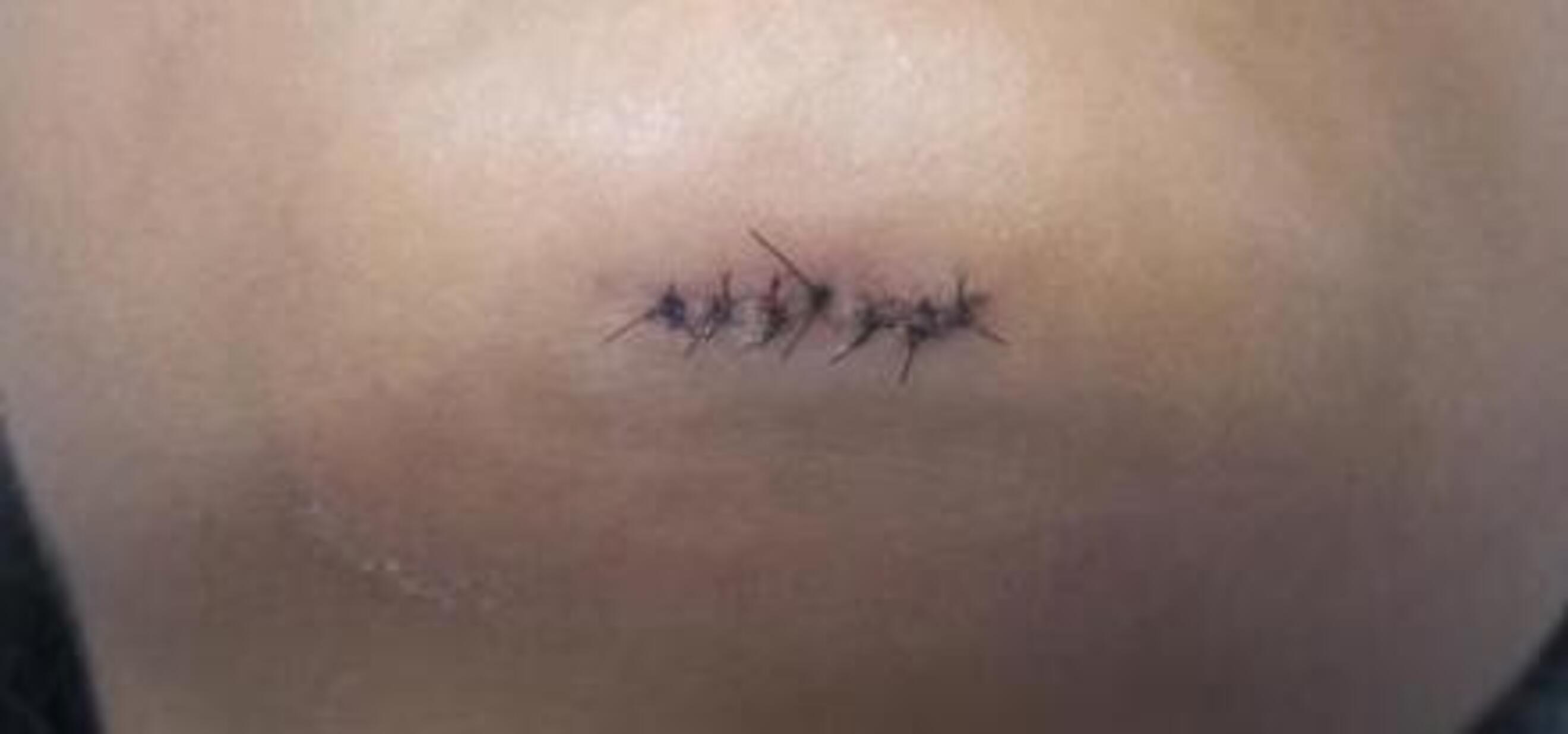 Punts de sutura en un mentó, en una imatge d'arxiu.